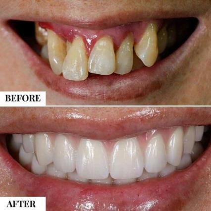 Implant supported smile